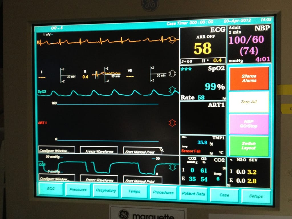 depth of anaesthesia monitoring